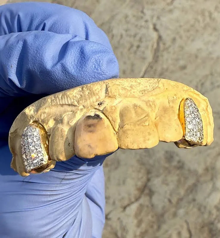 (Dental gold) single crown flooded vvs qaulity mossinite 💎 (For permanent use)