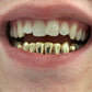 10k gold per tooth (single crown for permanent use)