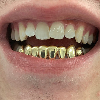 10kt gold per tooth (single crown for permanent use)