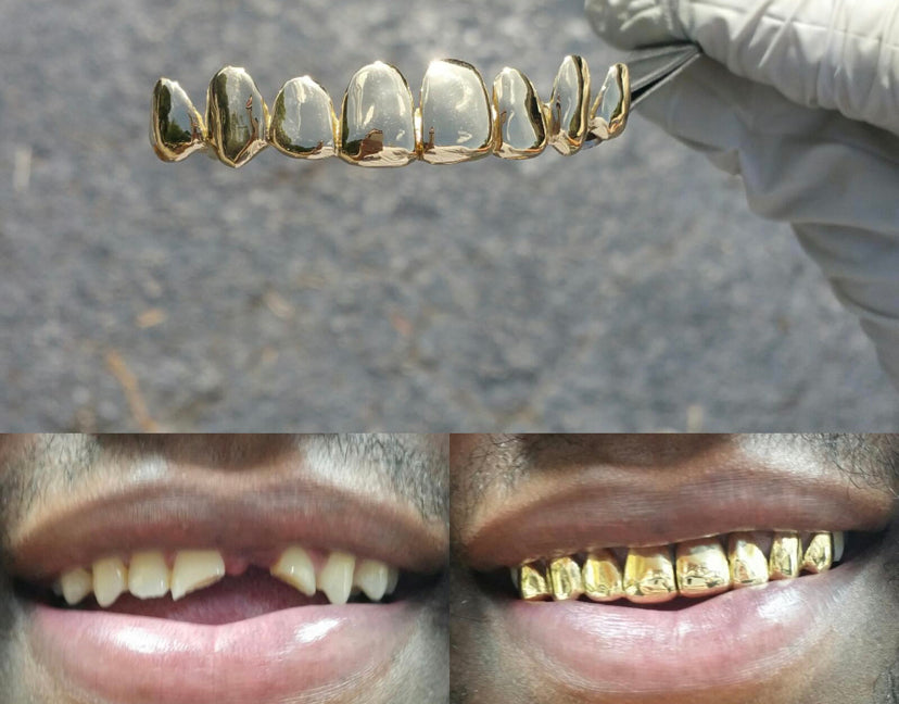 Replace missing tooth