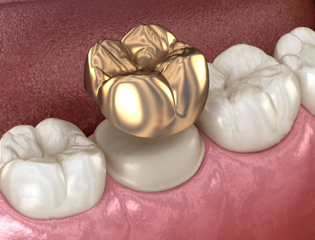 14kt Permanent teeth /crowns