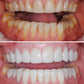 Composite veneers (per tooth)