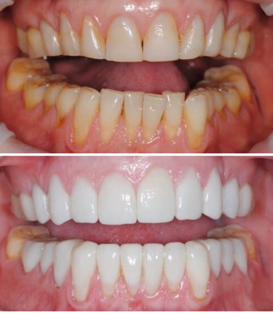 Composite veneers (per tooth)