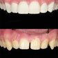 Composite veneers (per tooth)