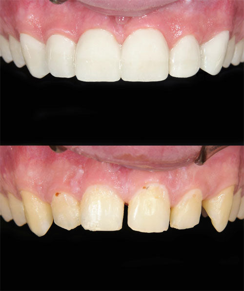 Composite veneers (per tooth)